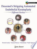 Descemet S Stripping Automated Endothelial Keratoplasty Different Strokes