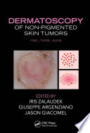 Dermatoscopy of Non Pigmented Skin Tumors