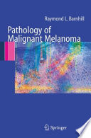 Pathology of Malignant Melanoma