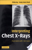 Interpreting Chest X-Rays