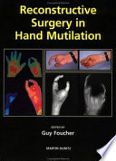 Reconstructive Surgery in Hand Mutilation