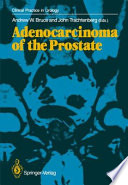 Adenocarcinoma of the Prostate Book