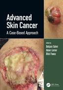 Advanced Skin Cancer Book