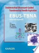 Endobronchial Ultrasound Guided Transbronchial Needle Aspiration